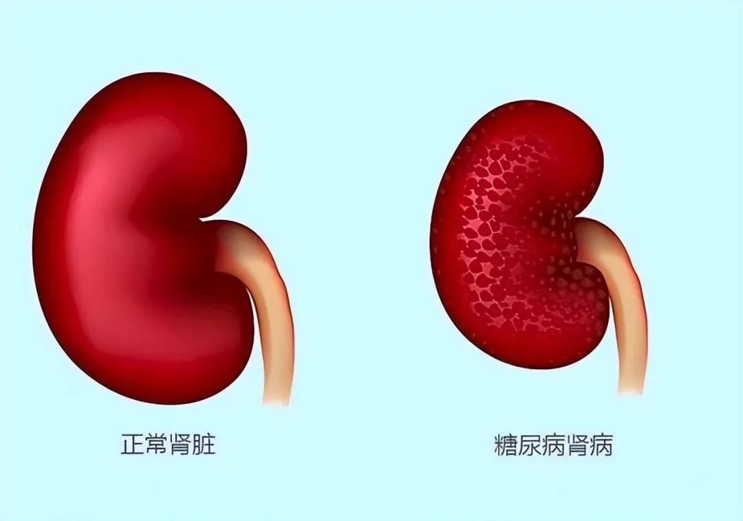 什么是糖尿病腎病？